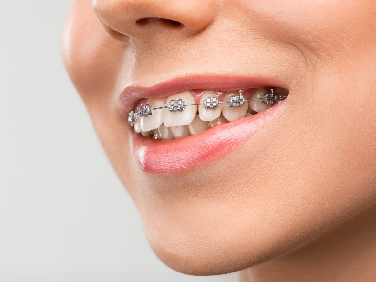 Dental Aligners