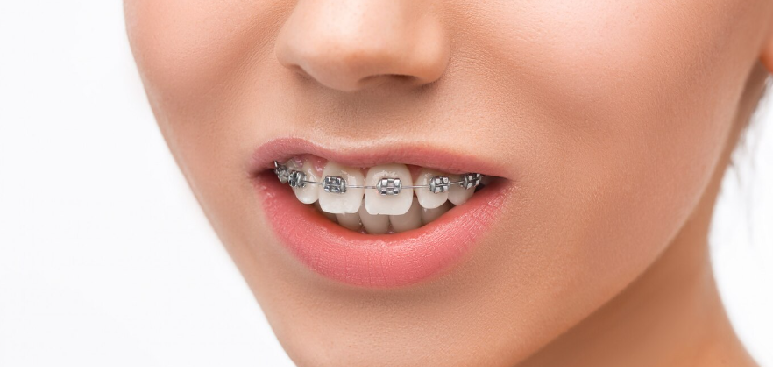 Dental Aligners